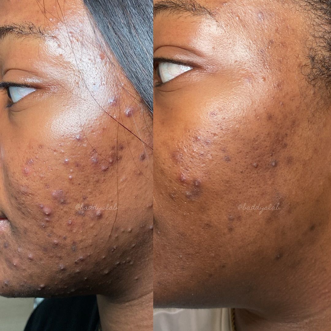 Mask Anti-Acné – Pour un visage lisse, sans boutons ni taches, pour Homme et Femme ✨