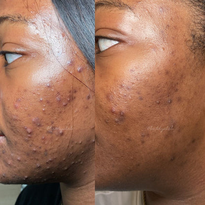 Mask Anti-Acné – Pour un visage lisse, sans boutons ni taches, pour Homme et Femme ✨