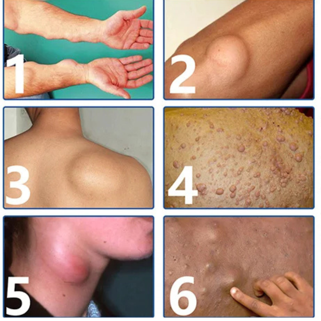 Fini les Boules sous la Peau, Crème pour éliminer les Lipome en 4 semaine ✨