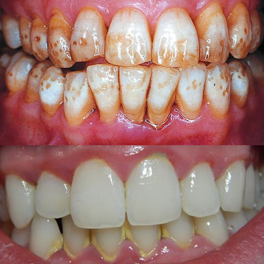 Dents Blanches 🦷 en 7 Jours ? C’est Possible avec Cette  Poudre dentaires !