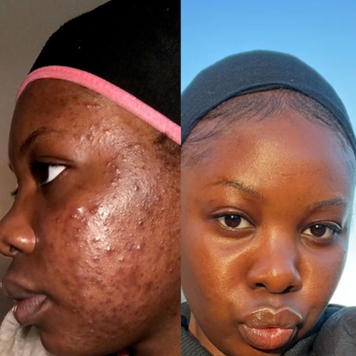 Mask Anti-Acné – Pour un visage lisse, sans boutons ni taches, pour Homme et Femme ✨